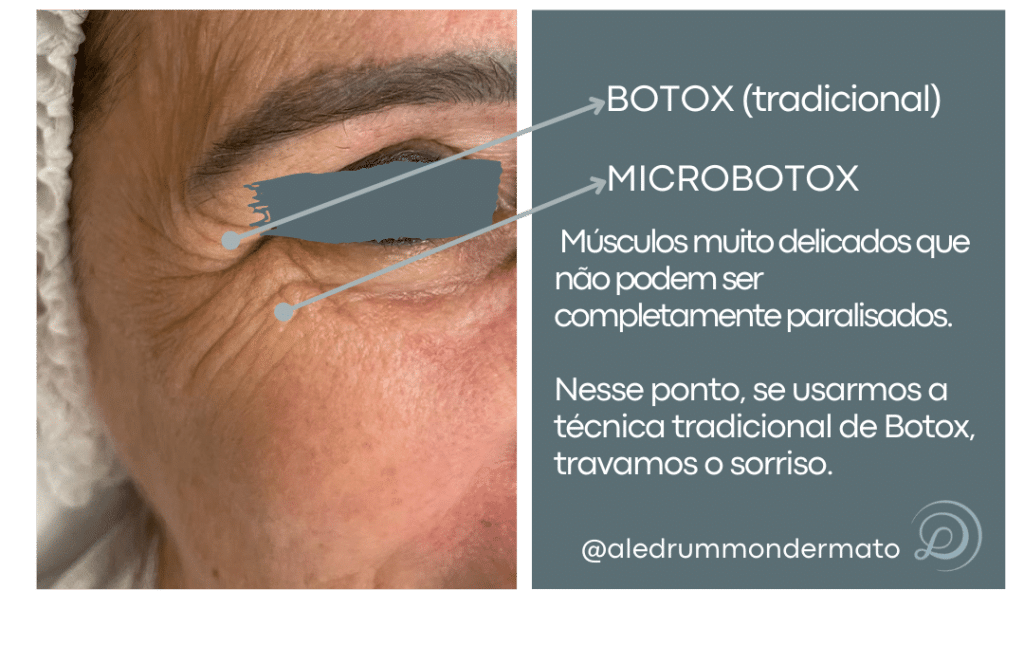 botox x microbotox