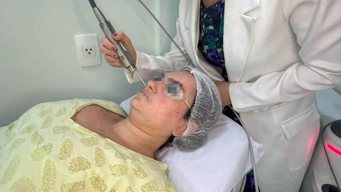 Laser Fotona para Rosácea