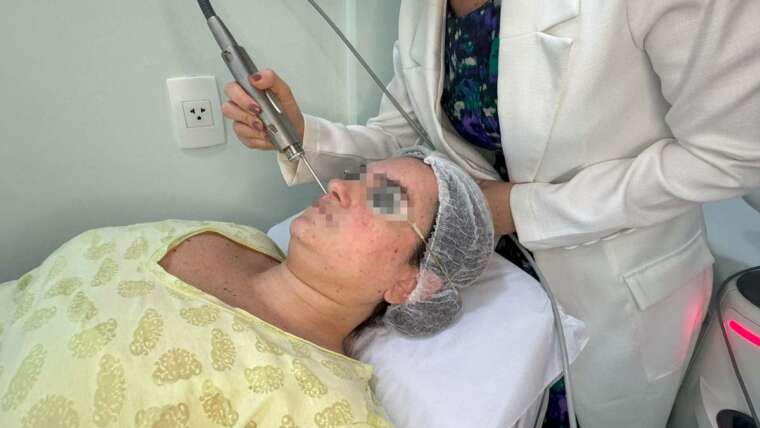 Laser Fotona para Rosácea
