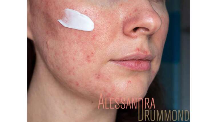 Qual a melhor rotina de skincare para quem tem rosácea?