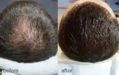 tratamento capilar com laser fotona antes e depois