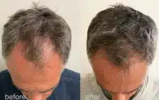 tratamento capilar com laser fotona